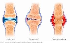 Lutut pengapuran tulang berbunyi ketika bergerak
