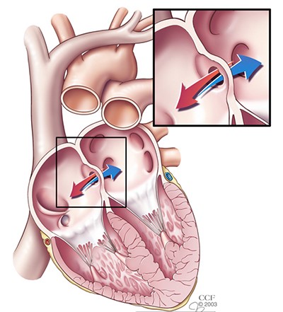 Terjadinya mengakibatkan di akan darah penyempitan terjadinya jantung pembuluh daerah Aterosklerosis Adalah?