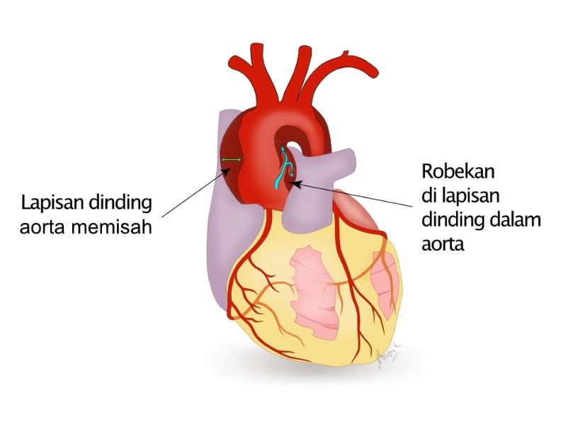 Robekan (Diseksi) Aorta atau Serangan Jantung