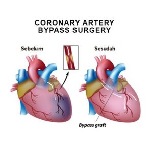 dr. Bagus Herlambang Lakukan Operasi Bypass Jantung Atau CABG Ke-3 Di ...