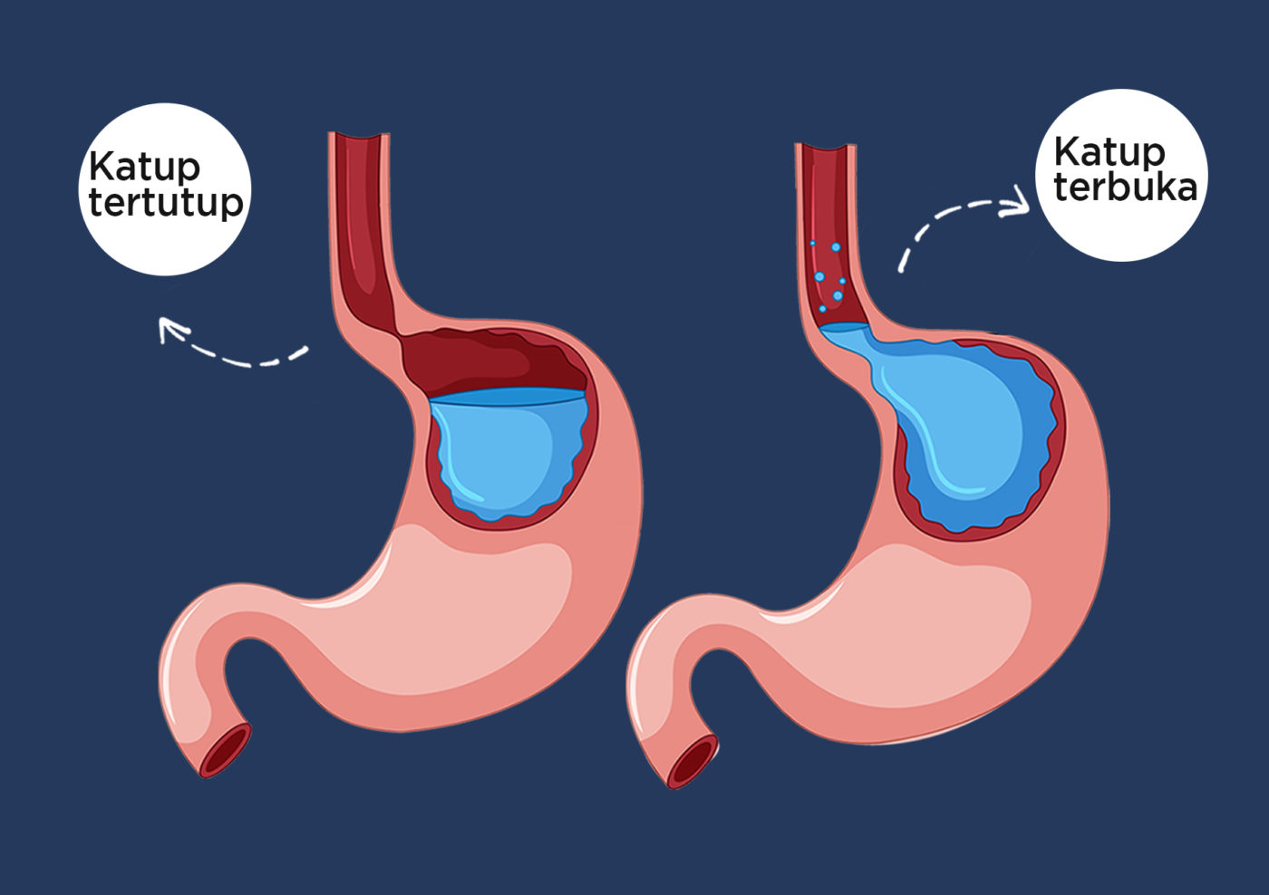 GERD (Gastroesophageal Reflux Disease) - Mandaya Hospital Group