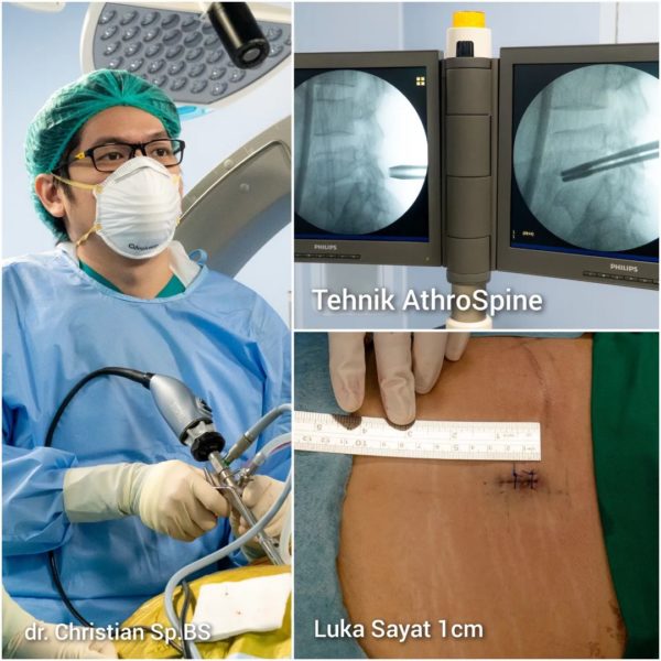 Operasi Saraf Kejepit ArthroSpine 1.5cm, Mandaya NeuroSpine Center