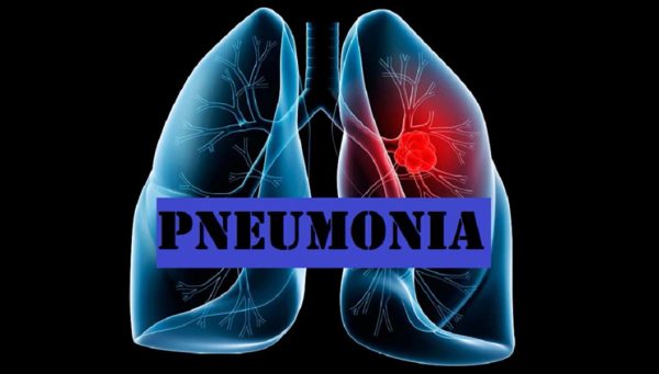 Pneumonia Anak