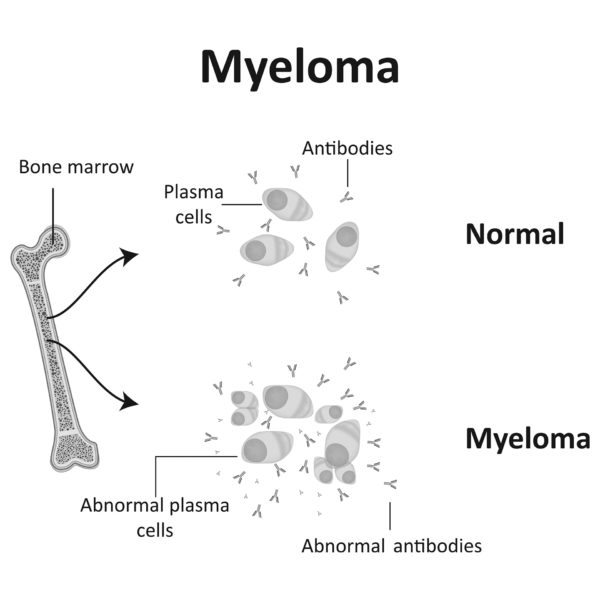 Perbedaan Kanker Darah Leukemia & Multiple Myeloma