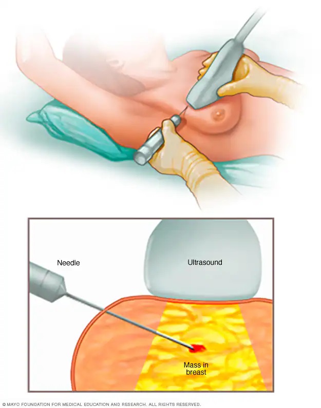 Biopsi payudara core needle