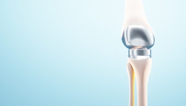 Jenis Implan Lutut untuk Solusi Pengapuran Tulang