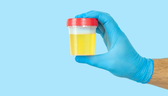 Tes Urine: Tujuan, Persiapan, dan Jenis Pemeriksaan