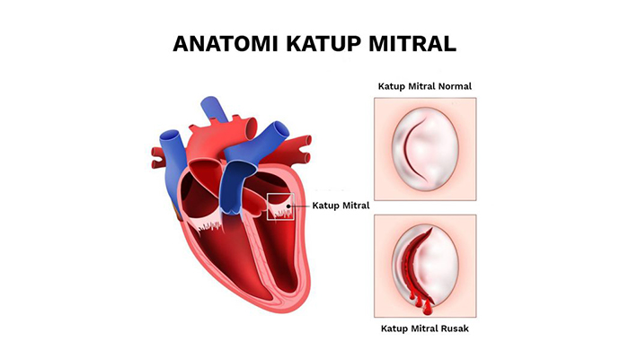 Operasi-katup-jantung