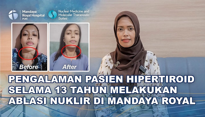 Kisah Inspiratif Ibu Yusnita: Hipertiroid Bisa Sembuh Dengan Ablasi Nuklir