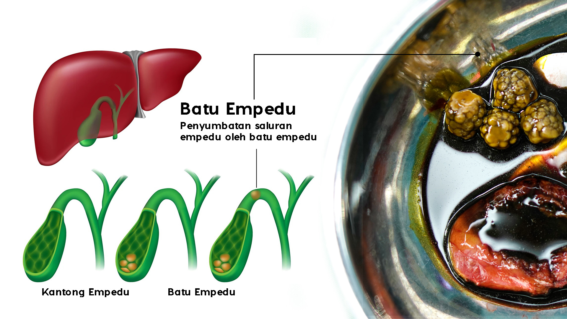 Metode Operasi Batu Empedu Minim Luka 1 cm Hanya di Mandaya Hospital Karawang