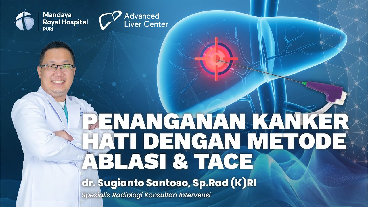 Mengenal Metode Ablasi RF/MWA & TACE Untuk Tangani Nodul Hati dan Kanker Hati