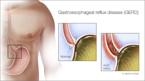 GERD (Sumber: Mayo Clinic)