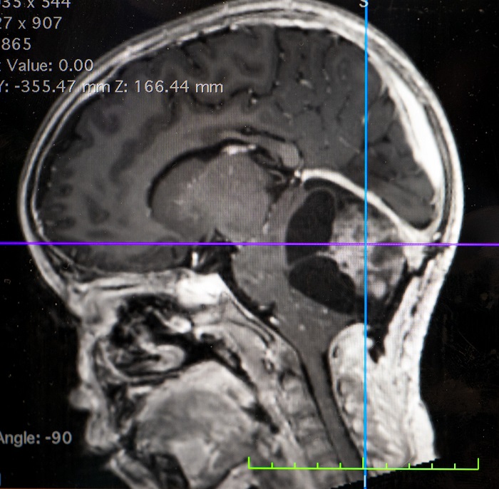 gambar tumor otak pada anak