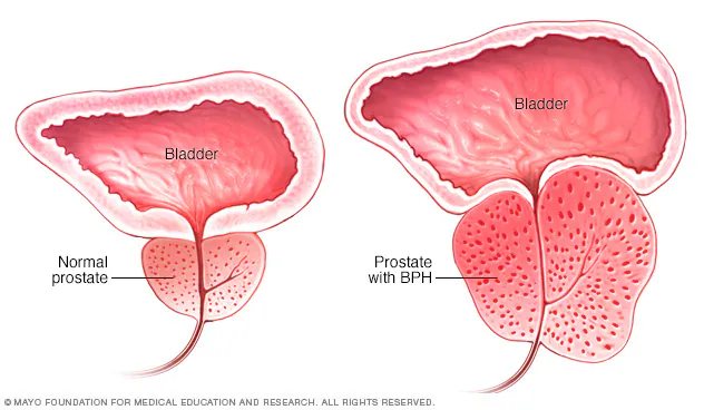 Pembesaran prostat jinak atau BPH benign prostate hyperplasia (BPH). (Sumber: Mayo Clinic)