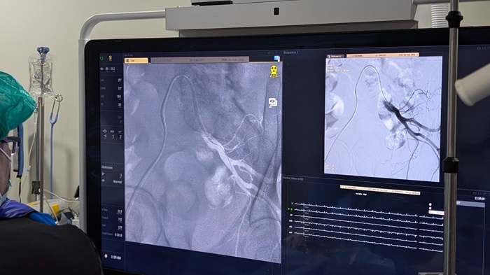 Prostatic Artery Embolization (PAE): Tujuan Dilakukan, Prosedur, Keunggulan, dan Efek Sampingnya