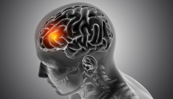 10 Gejala Tumor Otak yang Sering Disepelekan