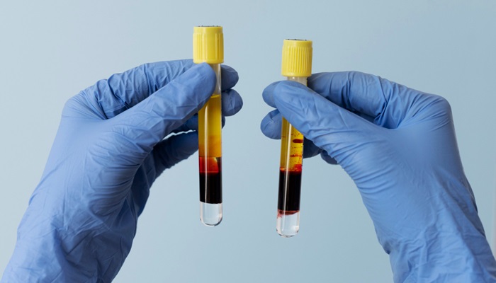 RS Mandaya Puri Kenalkan Terapi Cuci Plasma Darah Untuk Multiple Myeloma & Autoimun