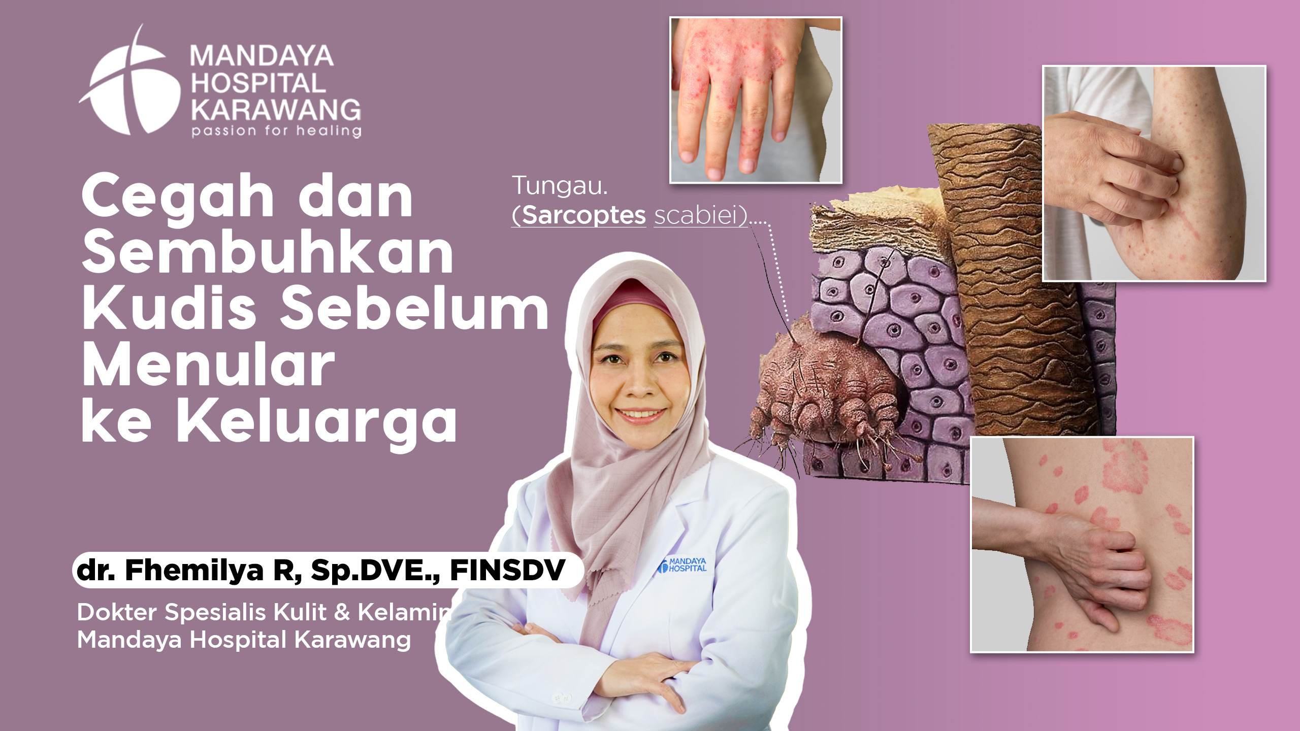 Cegah dan Sembuhkan Kudis Sebelum Menular – dr. Fhemilya R., Sp.DVE., FINSDV