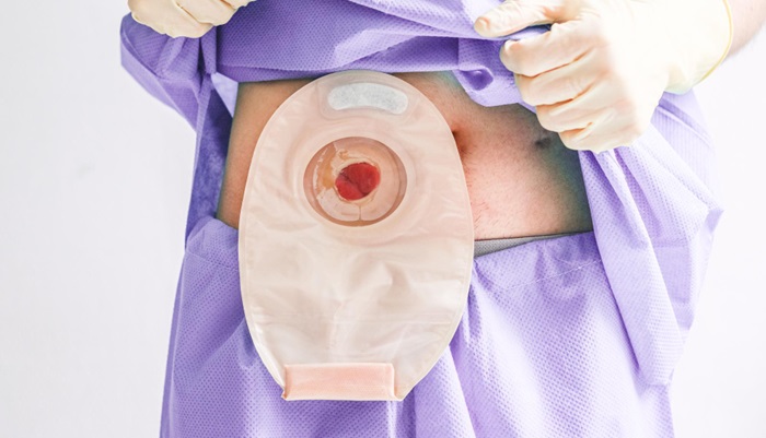 Kenapa Harus Dibuat Stoma atau Lubang Perut Pasca Operasi Usus Besar?