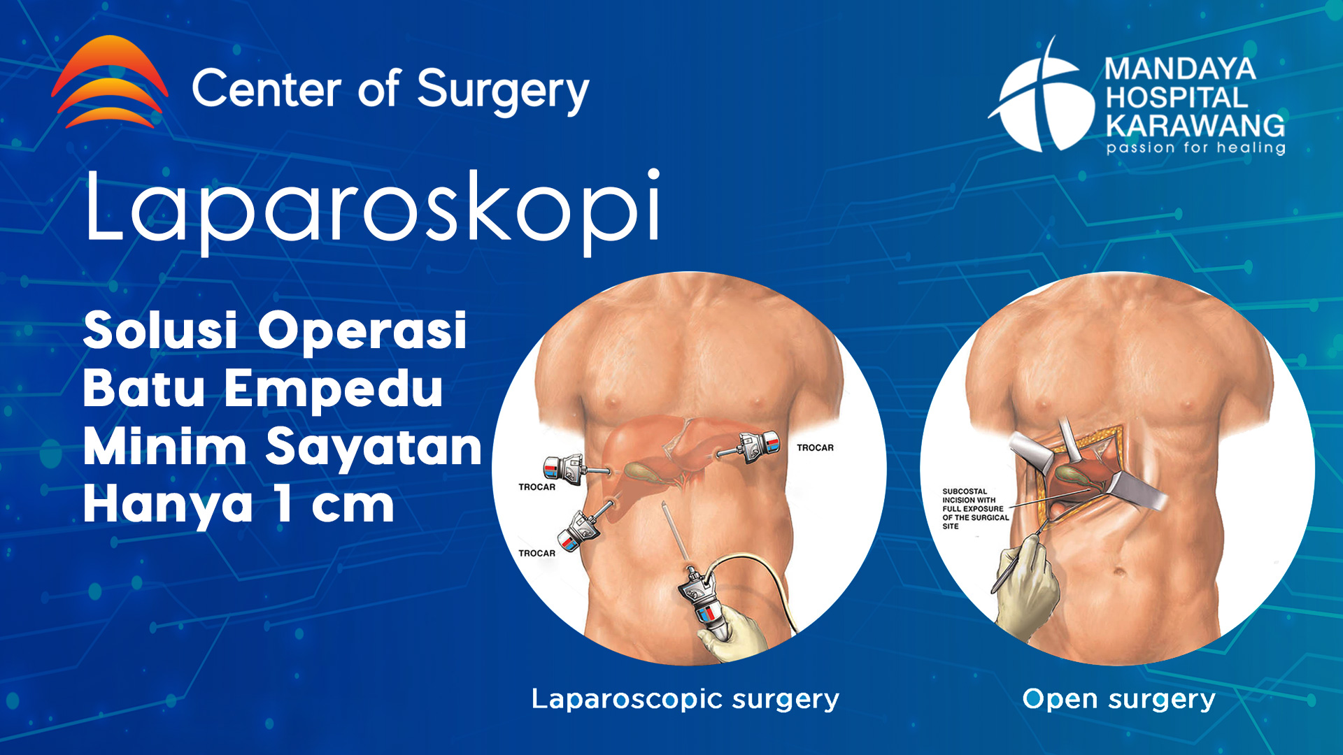 Laparoskopi: Solusi Bedah Batu Empedu dengan Luka Hanya 1 cm
