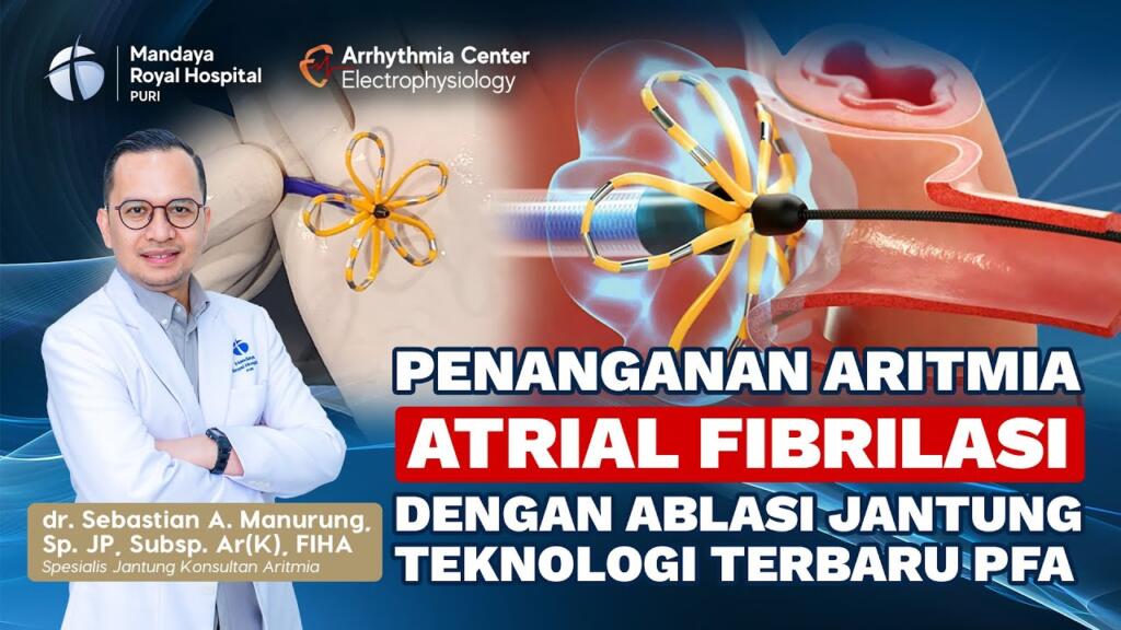 Mandaya Miliki Pusat Atrial Fibrilasi Jantung Berteknologi Terbaru, Pulsed Field Ablation (PFA)