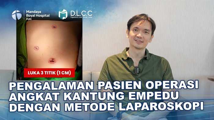 Pengalaman Pasien Lakukan Operasi Pengangkatan Kantong Empedu di RS Mandaya Puri, Luka Hanya 1 cm