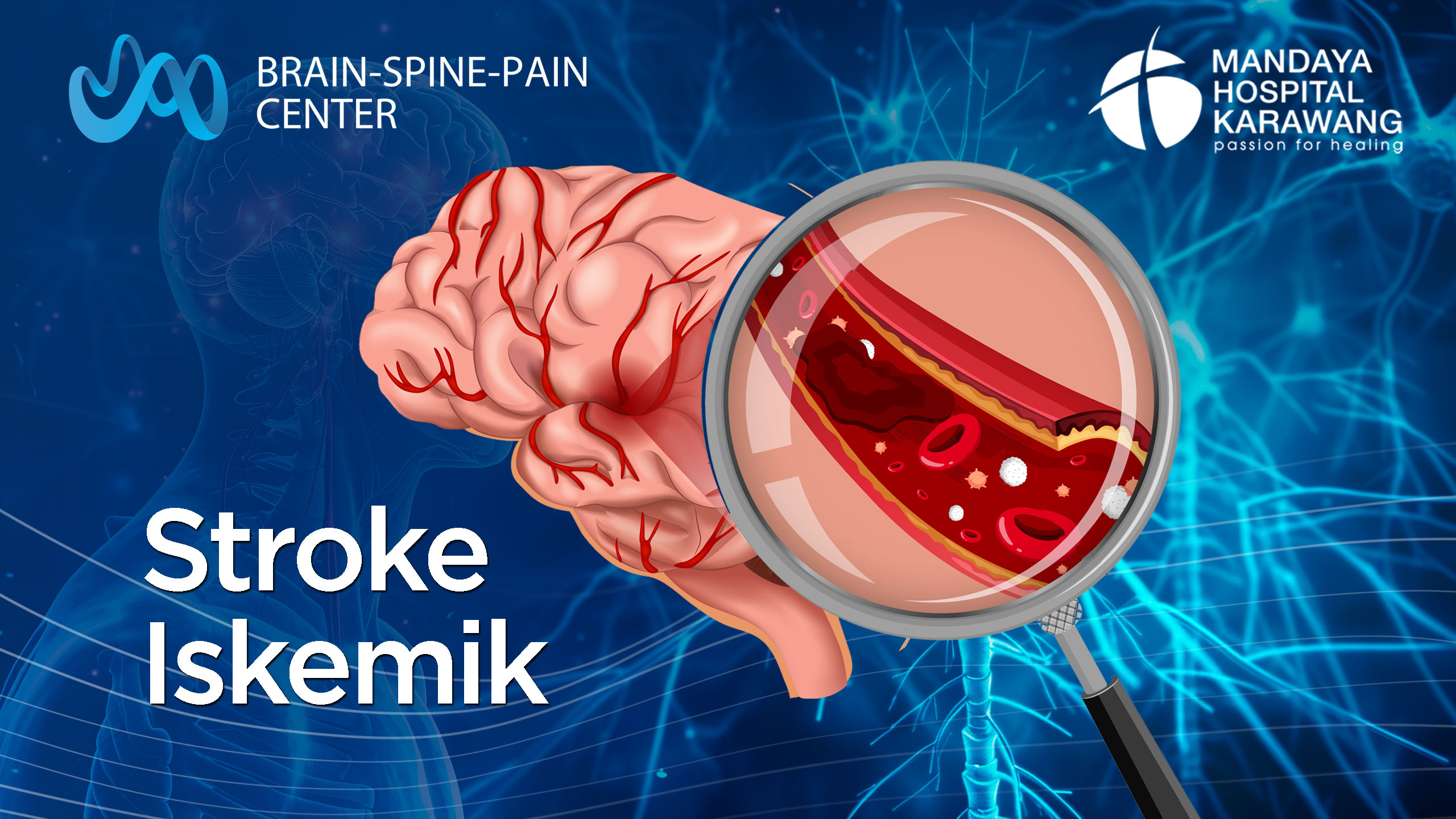 Stroke Iskemik: Gejala, Penyebab, dan Penanganan Dini