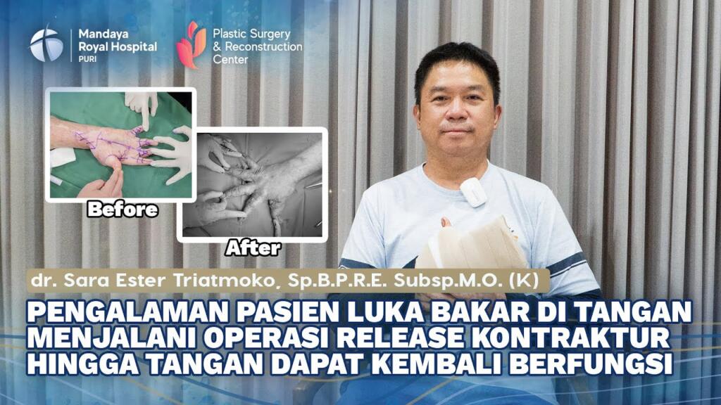 Pengalaman Pasien Luka Bakar Jalani Operasi Rilis Kontraktur di RS Mandaya Royal Puri