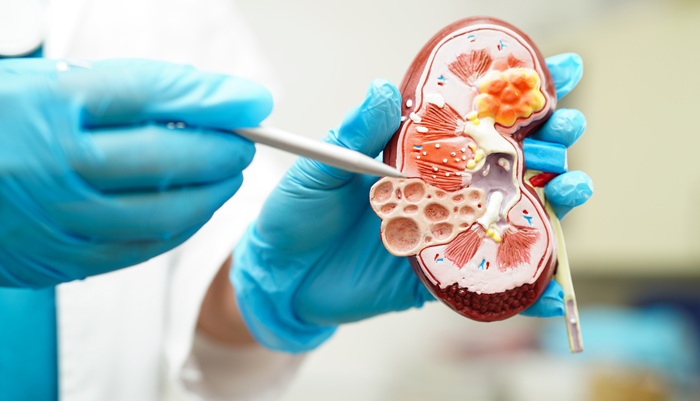Transplantasi Ginjal: Kapan Dilakukan dan Risikonya