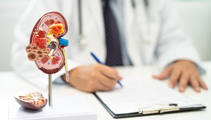 Kidney Stone Treatment Without Large Incisions at Mandaya Royal Hospital Puri