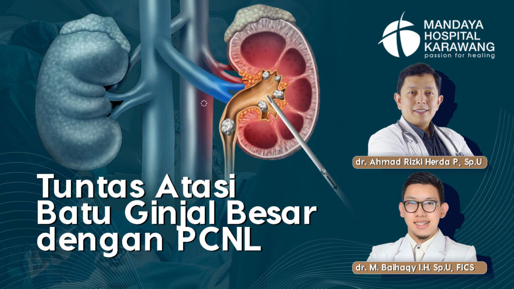 Atasi Batu Ginjal Besar dengan PCNL