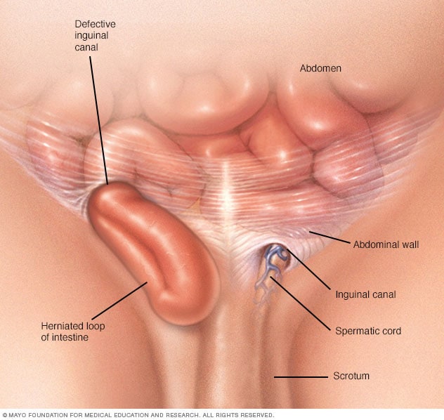 Hernia Inguinalis (Sumber: Mayo Clinic)