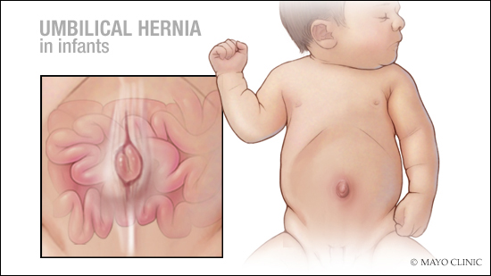 Hernia Umbilikalis (Sumber: Mayo Clinic)