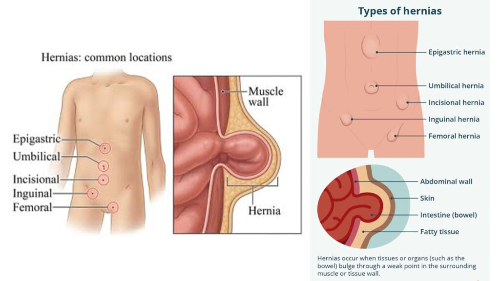 Hernia Inguinalis: Kenali Gejala, Penyebab, dan Cara Mengobatinya