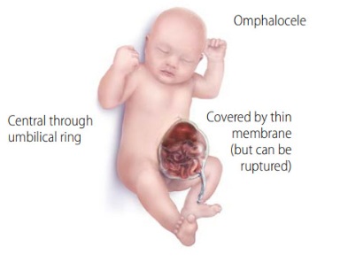 Omfalokel pada bayi (Sumber: Centers for Disease Control and Prevention) 