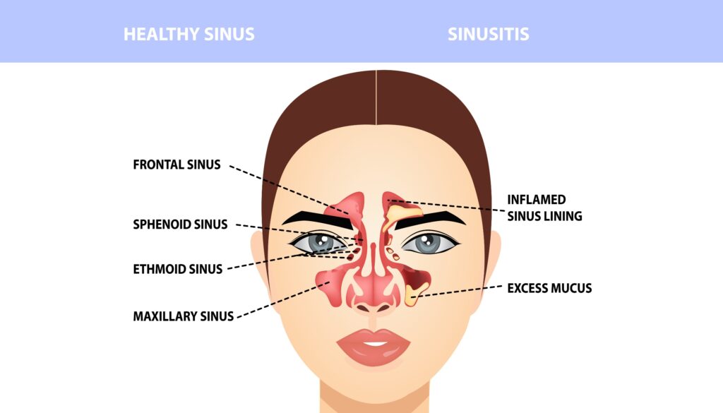 Pengobatan Sinusitis Tanpa Operasi Pakai Balon Bisa di RS Mandaya Puri