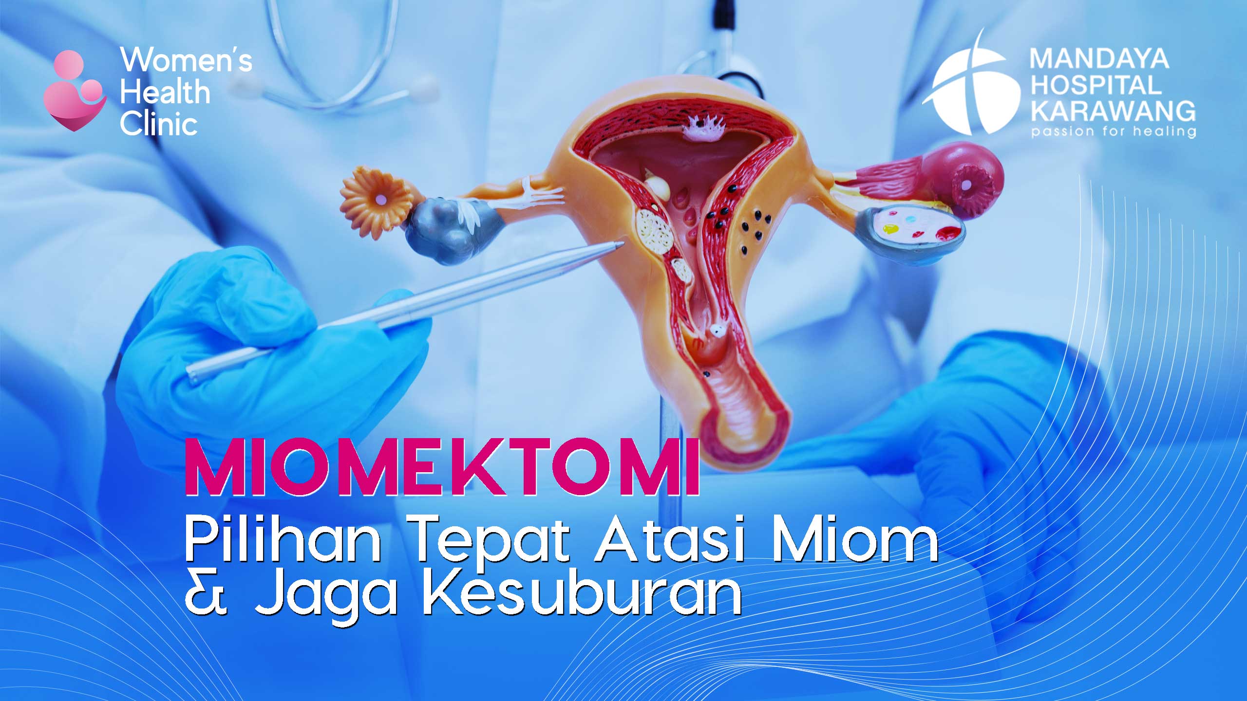 Miomektomi : Pilihan Tepat Atasi Miom & Jaga Kesuburan