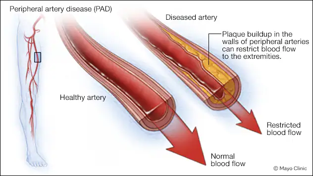 Penyakit Arteri Perifer (Sumber: Mayo Clinic)