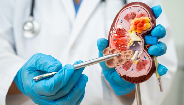 Kidney Tumor Treatment at Mandaya Royal Hospital Puri, Less Invasive and Faster Recovery