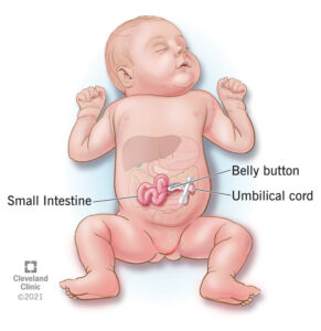 Gastroschisis pada bayi. (Sumber: Cleveland Clinic)