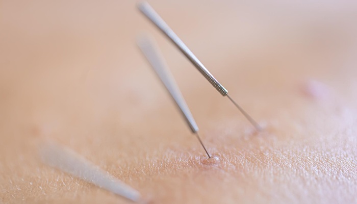 Get to Know Acupuncture and Doctor Recommendations at Mandaya Royal Puri Hospital