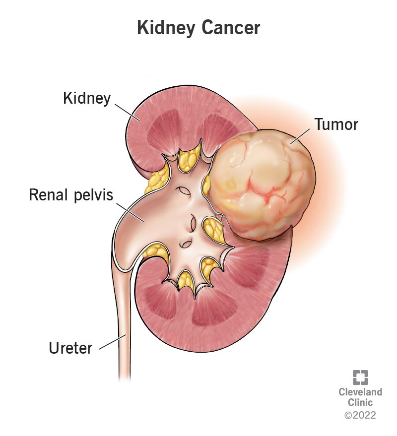Tumor ginjal (Sumber: Cleveland Clinic)