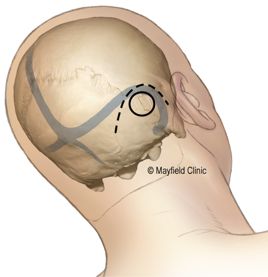 Prosedur MVD (Sumber: Mayfield Clinic)