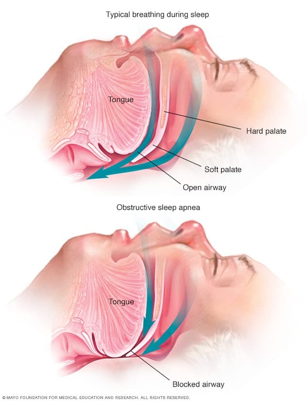 Sleep Apnea (Sumber: Mayo Clinic)