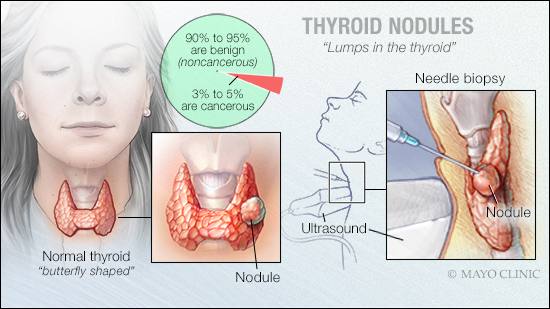 Nodul tiroid (Sumber: Mayo Clinic)