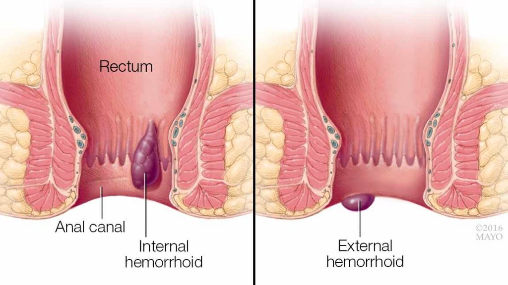 Wasir atau hemoroid (Sumber: Mayo Clinic)
