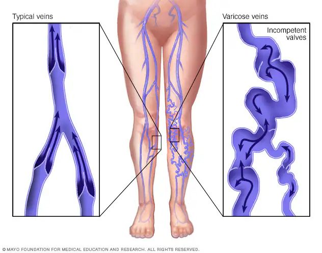 Skleroterapi (Sumber: Mayo Clinic)