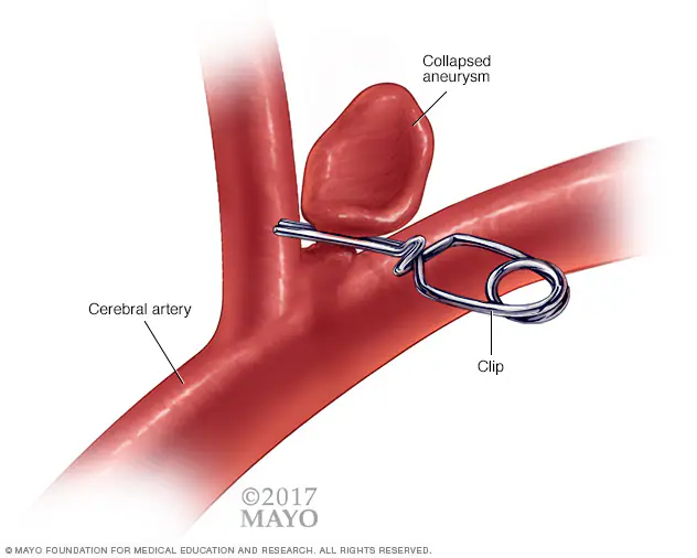 Microsurgical clipping (Sumber: Mayo Clinic)