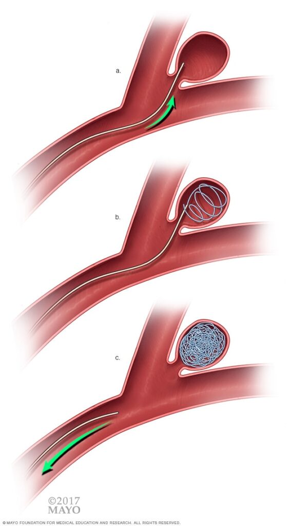 Endovascular coiling (Sumber: Mayo Clinic)