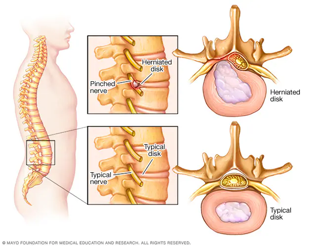Saraf kejepit (Sumber: Mayo Clinic)